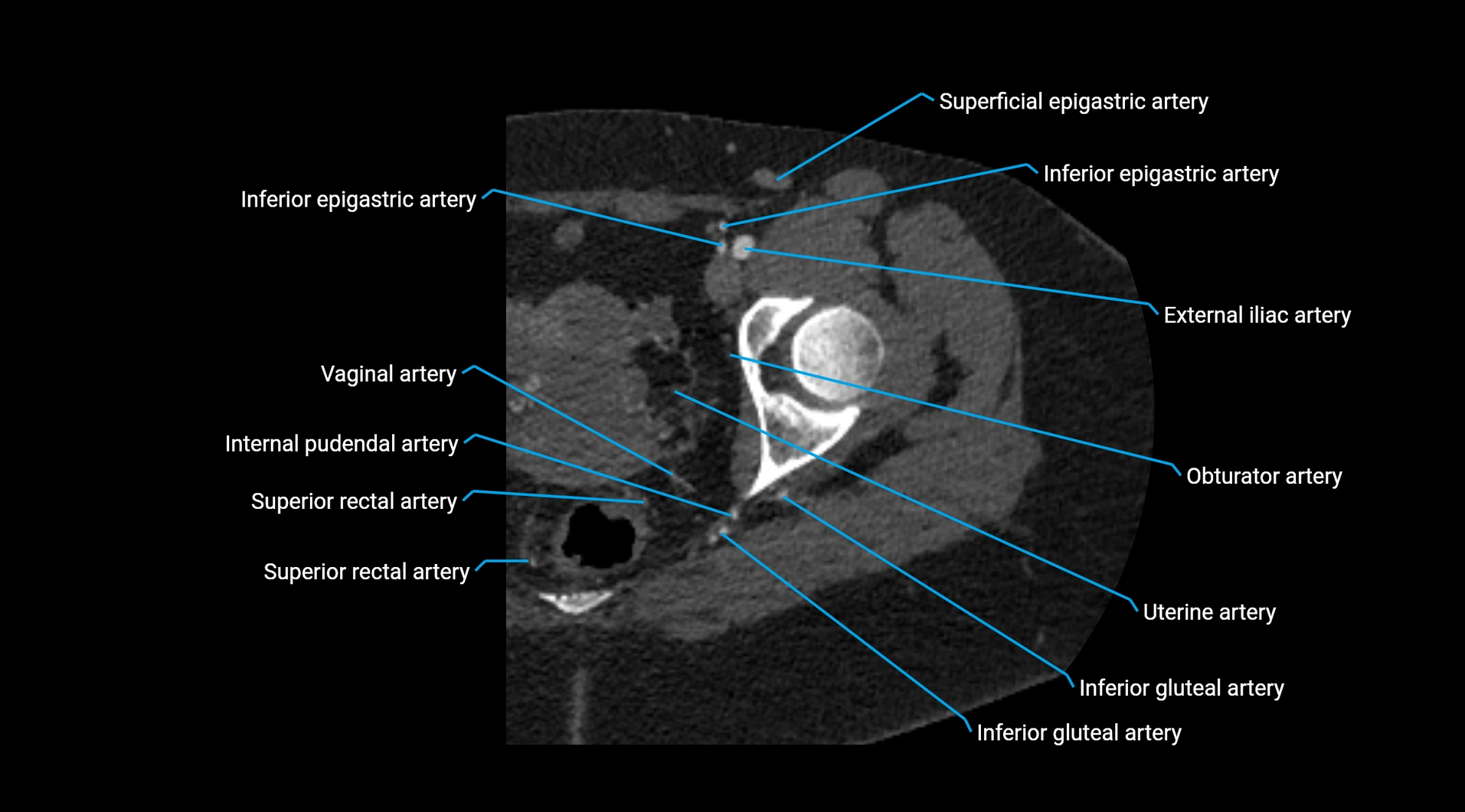 CTA lower limb cross sectional anatomy labelled image _51.webp